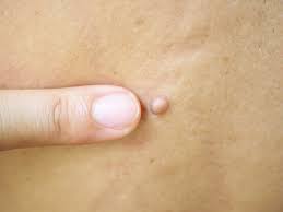 Skin Tag Removal Treatment: Top Solutions for a Smooth, Tag-Free Skin