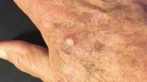 Actinic Keratosis Treatment Market Future Overview and Share, Forecast 2032