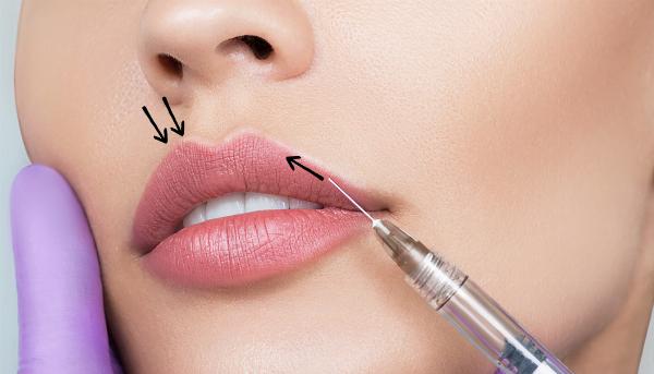 Russian Lip Fillers: A Guide to Precision and Elegance in Lip Enhancement
