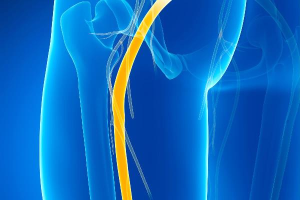 Understanding Femoral Nerve Radiculopathy: Symptoms, Causes, Diagnosis, and Treatment