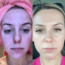 Red Light Therapy Before and After