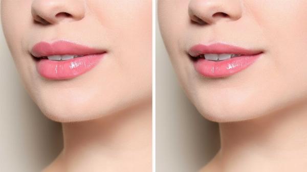 Post-Surgery Care for Lip Reduction in Islamabad