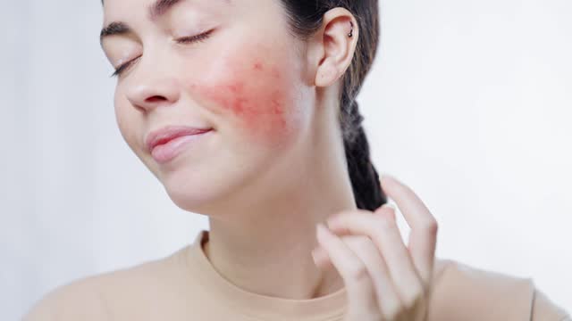 Regain Control Over Your Skin: Rosacea Treatment Options