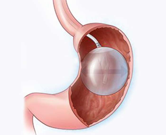 Benefits of Endoscopic Intragastric