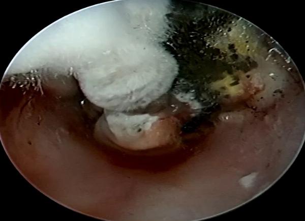 Otomycosis Treatment: How to Manage and Overcome Fungal Ear Infections