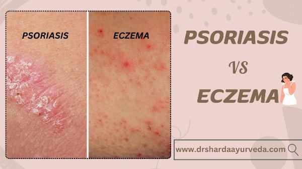 Psoriasis Vs Eczema: An Ayurvedic Perspective