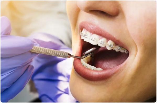 Finding the Best Braces Doctor in Malad West: Your Guide to Perfect Smiles