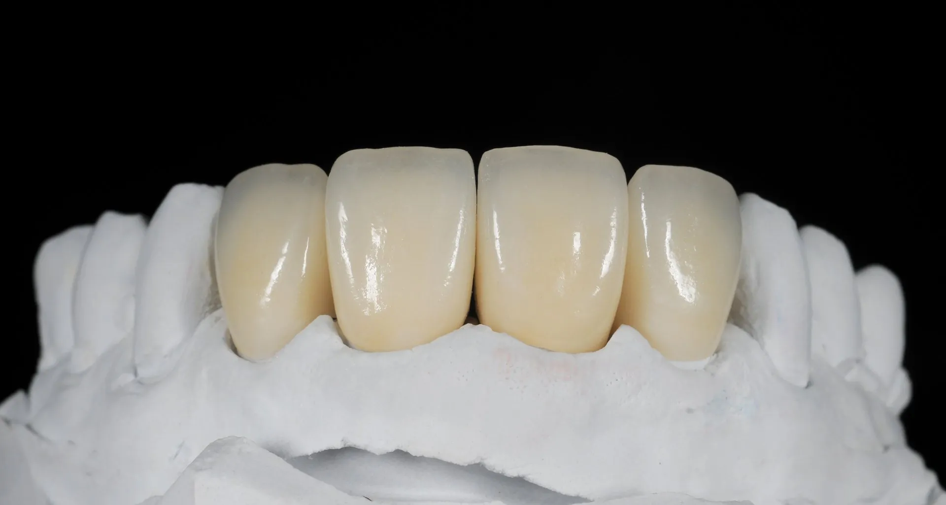 How to Care for Your Zirconia Crowns: Tips from Islamabad Dentists