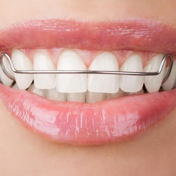 Dental Retainers: How They Help Maintain Your Perfect Smile
