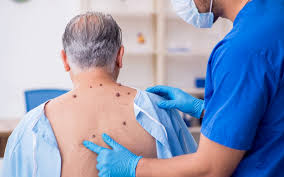 Removing Moles, Warts, and More: A Guide to Expert Lesion Removal