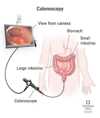 Choosing the Best Gastrologist in Hyderabad for Colonoscopy