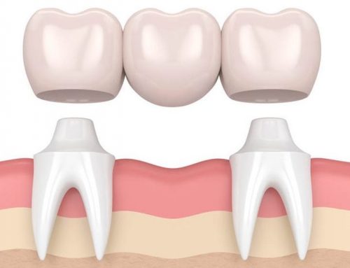 Your Guide to Dental Implant Practice Treatment Options