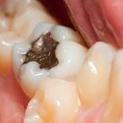 The Ultimate Guide to Tooth Fillings: Everything You Need to Know