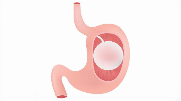 Everything You Need to Know About the Gastric Balloon in Riyadh