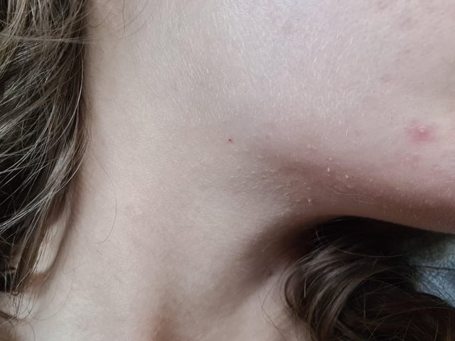Expert-Approved Milia Treatments for You