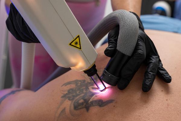 Laser Tattoo Removal Effective, Lasting Results
