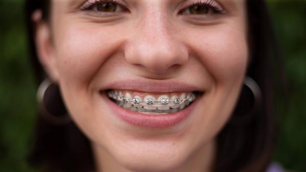 What Are Orthodontic Braces?