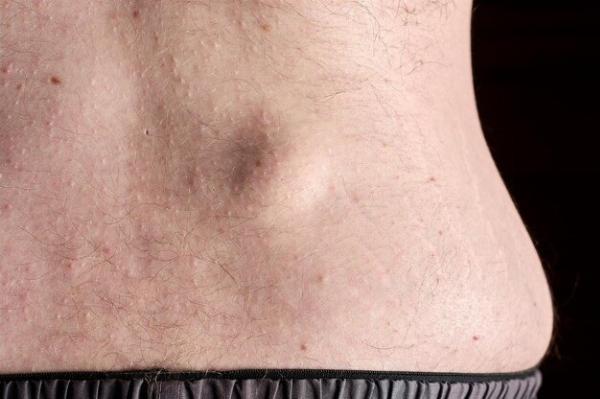 Lipoma Treatment: Risks and Complications