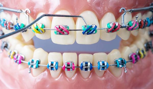 Orthodontics Market Demand Analysis, Statistics, Industry Trends And Investment Opportunities To 2032