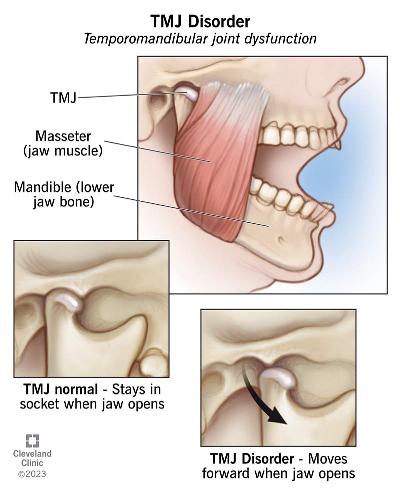 Maxillofacial Surgeon in Mumbai Can Help with TMJ Pain Relief