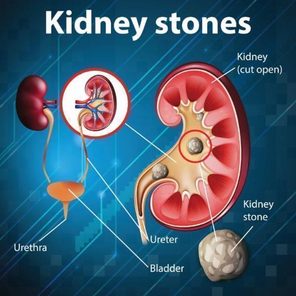 Being the Patient, not a Kidney Stone Patient