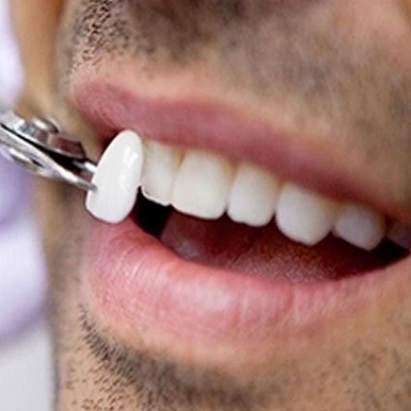 Transform Your Smile with E-max Veneers in Dubai: A Comprehensive Overview