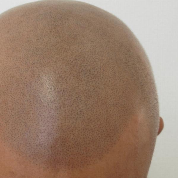 Scalp Micropigmentation: A Non-Surgical Option