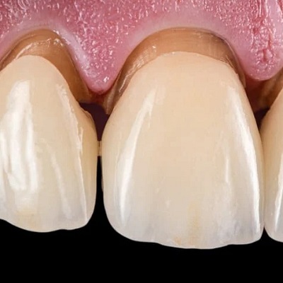 What Are E-max Veneers and How Do They Work?