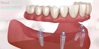 Trusted Smile Solutions Our Dental Implant Practice