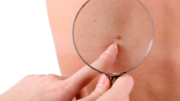 Dermoscopy in Dermatology: Revolutionizing Mole Evaluation Practices