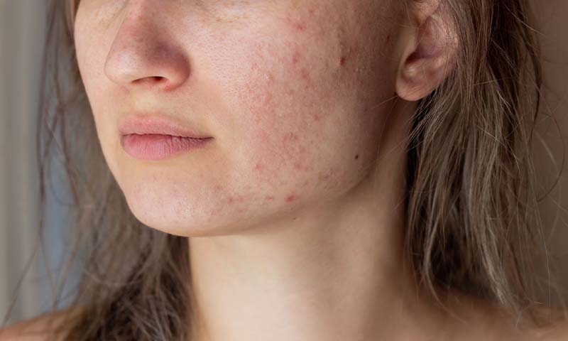 Blemish-Free Skin: Expert Tips to Fade Dark Spots