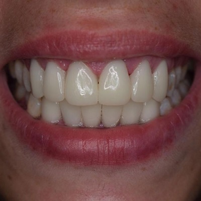E-Max Veneers: A Modern Solution for Perfect Teeth