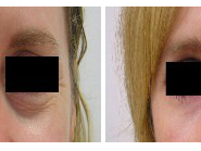 Understanding the Eyelid Surgery Consultation Process