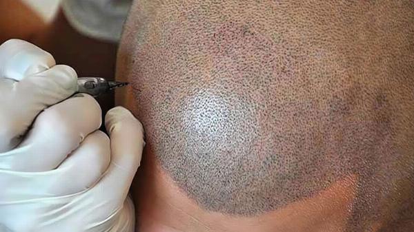 Enhance Hairline with Scalp Micropigmentation