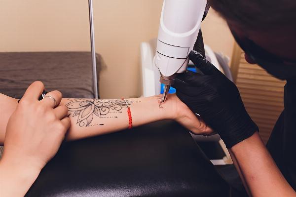 Laser Tattoo Removal A New You Awaits