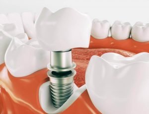 The Essential Benefits of Dental Implants for Every Patient