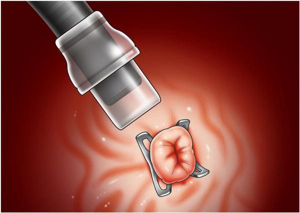 Endoscopic Closure Systems Market By Product, Growth and Research 2024-2032