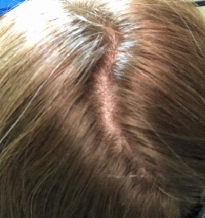 Scalp Micropigmentation Treatment Fuller Hair Without Surgery
