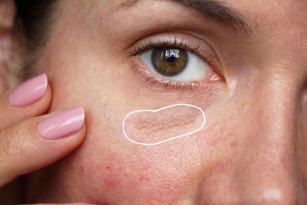 Proven Results Milia Treatments