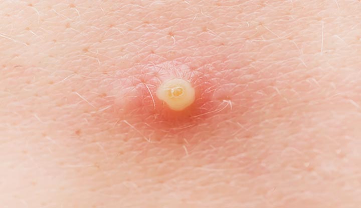 Get Relief Today: Incision and Drainage of Abscesses