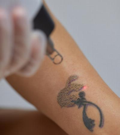Laser Tattoo Removal: Enjoy Life Without Regrets