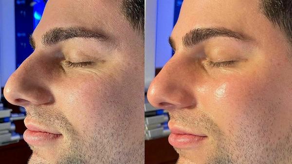 What Can Men Expect During a HydraFacial Session?