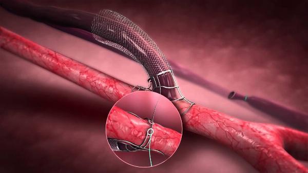 Arteriovenous Fistula Devices Market 2029: Surprising Facts and Future Projections Exposed