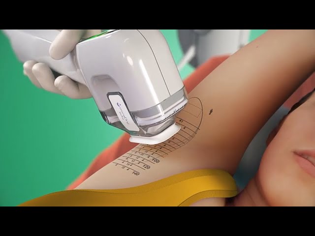 The Truth About MiraDry Treatment: Everything You Should Know
