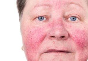 Rosacea Treatment Clear Skin Awaits