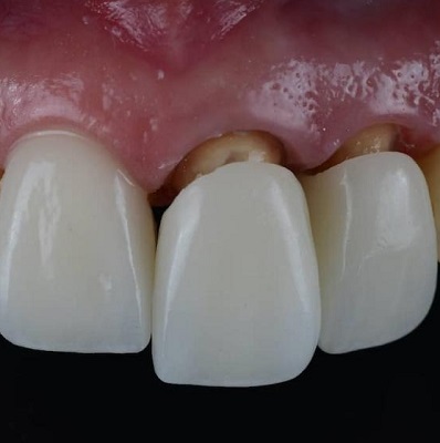 The Role of Bone Density in Dental Implant Success