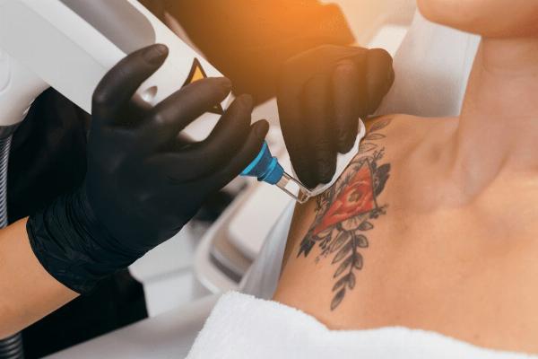 The Future of Tattoo Removal Laser Technology