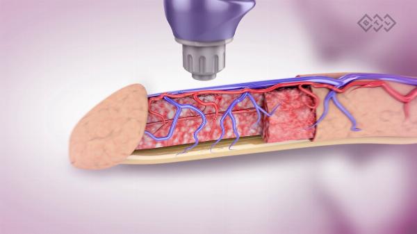 Benefits of Shockwave Therapy Over Traditional ED Treatments