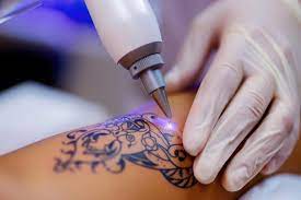 Laser Tattoo Removal: What You Should Know