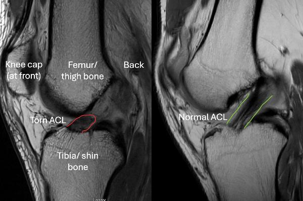 Acl Injuries London,Best Knee Surgeon London